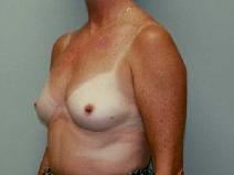 Breast Augmentation Before Photo by William Dascombe, MD; Savannah, GA - Case 2116
