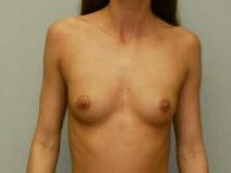 Breast Augmentation Before Photo by William Dascombe, MD; Savannah, GA - Case 2135
