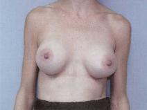 Breast Augmentation After Photo by William Dascombe, MD; Savannah, GA - Case 2203