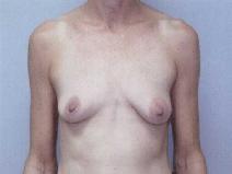 Breast Augmentation Before Photo by William Dascombe, MD; Savannah, GA - Case 2203