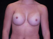 Breast Augmentation After Photo by William Dascombe, MD; Savannah, GA - Case 2241
