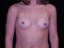 Breast Augmentation Before Photo by William Dascombe, MD; Savannah, GA - Case 2241