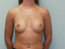 Breast Augmentation Before Photo by William Dascombe, MD; Savannah, GA - Case 2299