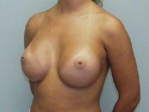 Breast Augmentation After Photo by William Dascombe, MD; Savannah, GA - Case 2299