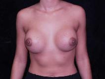 Breast Augmentation After Photo by William Dascombe, MD; Savannah, GA - Case 2317