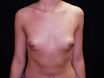 Breast Augmentation Before Photo by William Dascombe, MD; Savannah, GA - Case 2317