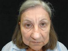 Eyelid Surgery Before Photo by William Dascombe, MD; Savannah, GA - Case 29756