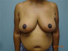 Breast Reduction After Photo by William Dascombe, MD; Savannah, GA - Case 29757