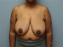 Breast Reduction Before Photo by William Dascombe, MD; Savannah, GA - Case 29757
