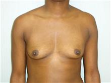 Breast Augmentation Before Photo by William Dascombe, MD; Savannah, GA - Case 29758