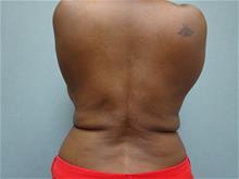 Liposuction After Photo by William Dascombe, MD; Savannah, GA - Case 29759