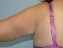 Arm Lift After Photo by Lucie Capek, MD; Cohoes, NY - Case 10512