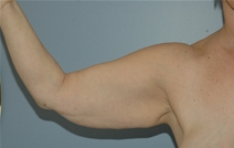 Arm Lift Before Photo by Lucie Capek, MD; Cohoes, NY - Case 10513
