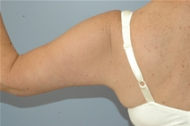 Arm Lift After Photo by Lucie Capek, MD; Cohoes, NY - Case 10513