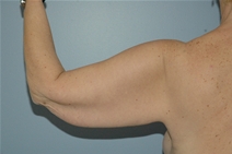 Arm Lift Before Photo by Lucie Capek, MD; Cohoes, NY - Case 10513