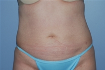 Liposuction After Photo by Lucie Capek, MD; Latham, NY - Case 20252