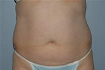 Liposuction Before Photo by Lucie Capek, MD; Latham, NY - Case 20252