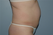 Liposuction Before Photo by Lucie Capek, MD; Cohoes, NY - Case 20252