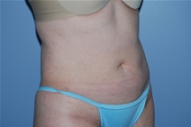 Liposuction After Photo by Lucie Capek, MD; Cohoes, NY - Case 20252