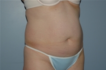 Liposuction Before Photo by Lucie Capek, MD; Cohoes, NY - Case 20252