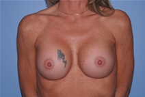 Breast Augmentation After Photo by Lucie Capek, MD; Cohoes, NY - Case 20258