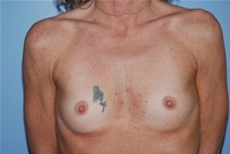 Breast Augmentation Before Photo by Lucie Capek, MD; Cohoes, NY - Case 20258