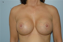Breast Augmentation After Photo by Lucie Capek, MD; Cohoes, NY - Case 21471