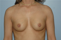 Breast Augmentation Before Photo by Lucie Capek, MD; Cohoes, NY - Case 21471