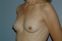 Breast Augmentation Before Photo by Lucie Capek, MD; Cohoes, NY - Case 21476