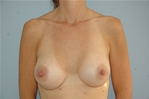 Breast Augmentation After Photo by Lucie Capek, MD; Cohoes, NY - Case 21478