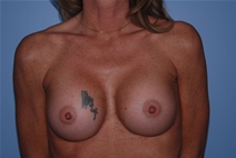 Breast Augmentation After Photo by Lucie Capek, MD; Cohoes, NY - Case 21479