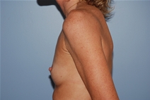 Breast Augmentation Before Photo by Lucie Capek, MD; Cohoes, NY - Case 21479