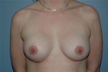 Breast Augmentation After Photo by Lucie Capek, MD; Cohoes, NY - Case 21480