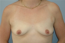 Breast Augmentation Before Photo by Lucie Capek, MD; Cohoes, NY - Case 21480