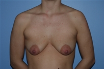 Breast Augmentation Before Photo by Lucie Capek, MD; Cohoes, NY - Case 21481