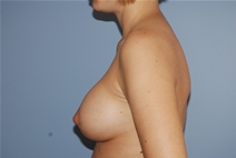 Breast Augmentation After Photo by Lucie Capek, MD; Cohoes, NY - Case 21481