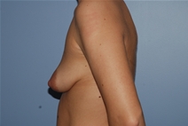 Breast Augmentation Before Photo by Lucie Capek, MD; Cohoes, NY - Case 21481