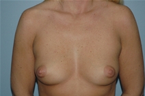 Breast Augmentation Before Photo by Lucie Capek, MD; Cohoes, NY - Case 21482