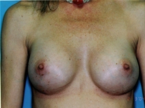 Breast Augmentation After Photo by Lucie Capek, MD; Cohoes, NY - Case 21483