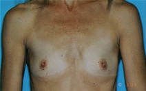 Breast Augmentation Before Photo by Lucie Capek, MD; Cohoes, NY - Case 21483