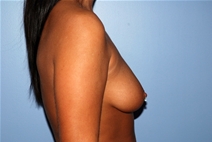 Breast Augmentation Before Photo by Lucie Capek, MD; Cohoes, NY - Case 21485