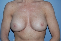 Breast Augmentation After Photo by Lucie Capek, MD; Cohoes, NY - Case 21490