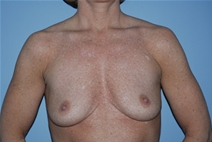 Breast Augmentation Before Photo by Lucie Capek, MD; Cohoes, NY - Case 21490