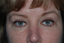 Eyelid Surgery After Photo by Lucie Capek, MD; Cohoes, NY - Case 21492