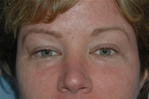 Eyelid Surgery Before Photo by Lucie Capek, MD; Cohoes, NY - Case 21492