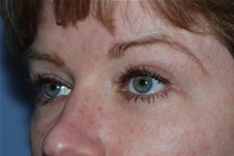 Eyelid Surgery After Photo by Lucie Capek, MD; Cohoes, NY - Case 21492