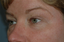 Eyelid Surgery Before Photo by Lucie Capek, MD; Cohoes, NY - Case 21492
