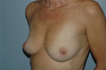 Breast Augmentation Before Photo by Lucie Capek, MD; Cohoes, NY - Case 21496