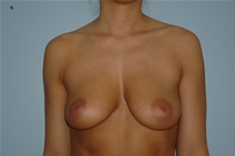 Breast Augmentation Before Photo by Lucie Capek, MD; Cohoes, NY - Case 21499
