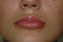 Dermal Fillers After Photo by Lucie Capek, MD; Latham, NY - Case 21500